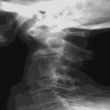 (PDF) Atlanto-Axial Instability in Rheumatoid Arthritis