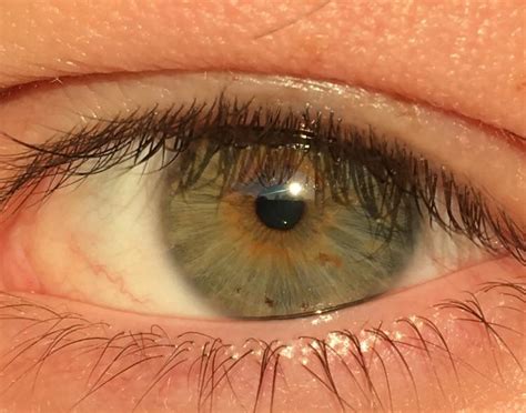 Green Hazel Or Central Heterochromia Reyes