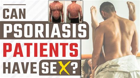 सरयसस मरज क समभग करन चहए य नह How Psoriasis Cause Sex