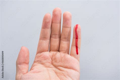 Bleeding Blood From The Cut Finger Wound Injured Finger With Bleeding