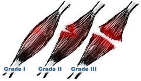 Intercostal Muscle Strain - Treatment - (updated in 2022)