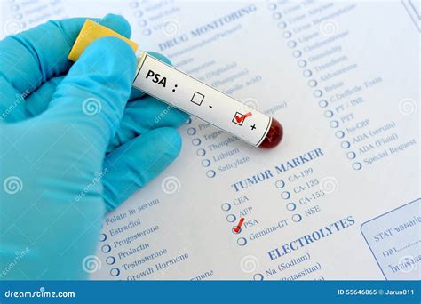 PSA Positive Stock Image Image Of Hematology Immunology 55646865