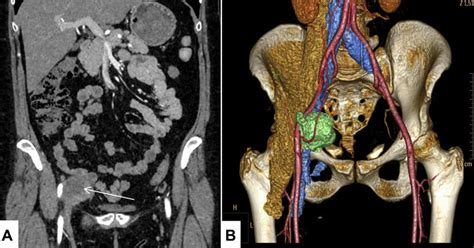 Contrast Enhanced Computed Tomography Of The Abdominal Cavity And Small Download Scientific