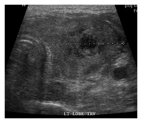 Thyroid Sonogram Showing A 3 7 × 2 5 × 2 9 Cm Oval Download