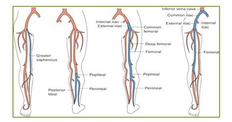 Superficial Thrombophlebitis Superficial Venous Thrombosis The Bmj Images