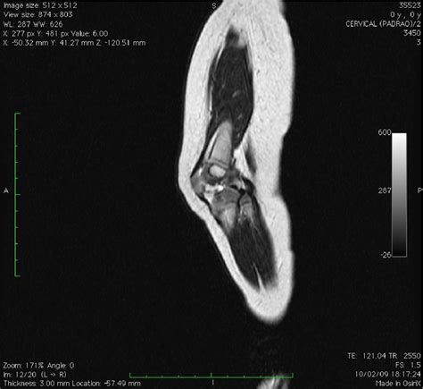 Figure 1 From Popliteal Pterygium Syndrome Semantic Scholar