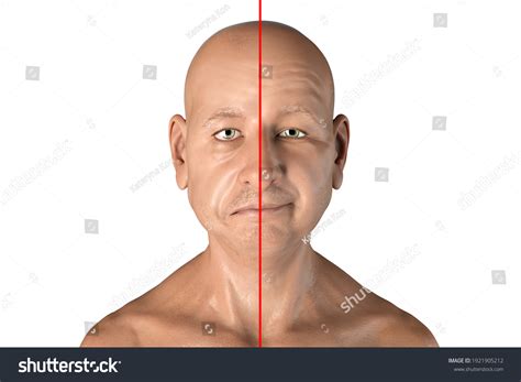 Facial Nerve Paralysis Bells Palsy 3d Hình Minh Họa Có Sẵn 1921905212 Shutterstock