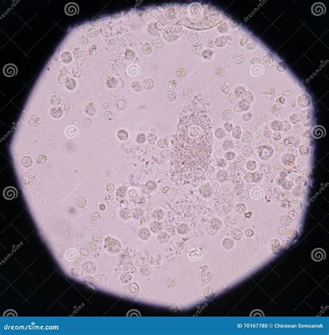 Moderate White Blood Cells,red Blood Cells,bacteria Cells In Uri Stock