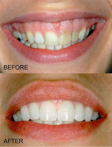 What Is A Gummy Smile Dallas Periodontal Associates