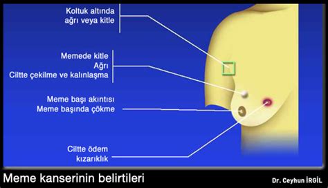 Meme Kanserİ Nedİr Tedavisi Nedir Biem Ilaç