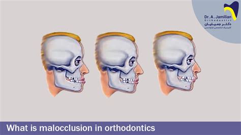 What Is Malocclusion In Orthodontics Dr Jamilian