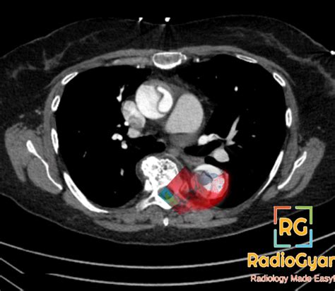 Aortic Dissection Radiology Reference Article Radiogyan