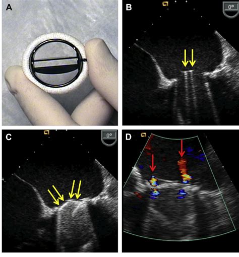 Figure From Mitral Prosthetic Valve Assessment By Echocardiographic