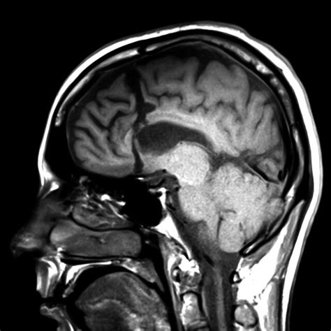 Postsurgical Mri Including Sagittal T1‐weighted Image That Demonstrates Download Scientific