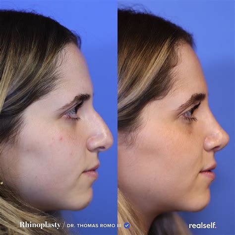 Rhinoplasty The Ultimate Guide To A Nose Job Realself Nose Job