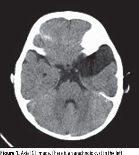 Figure 1 From Spontaneous Rupture Of The Middle Fossa Arachnoid Cyst