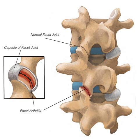 Understanding Facet Arthropathy A Common Cause Of Low Back And Neck Pain