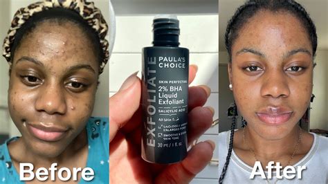 I Tried Paula S Choice Skin Perfecting 2 BHA Liquid Exfoliant For 2