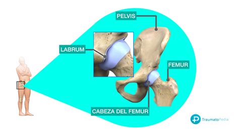 Complicaciones De La Artroscopia De Cadera Traumatopedia