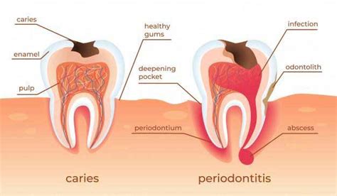 Gum Disease and It’s Causes | Drs. Leaman, Setnicar & Piacsek