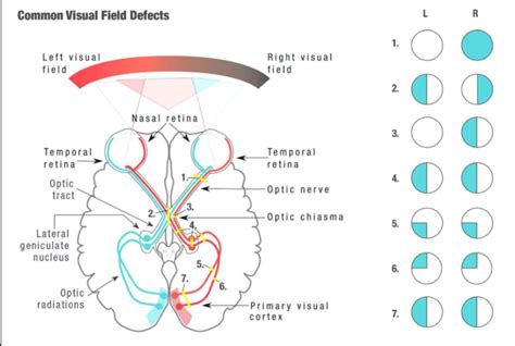 Visual Field Defects Diagram | Quizlet