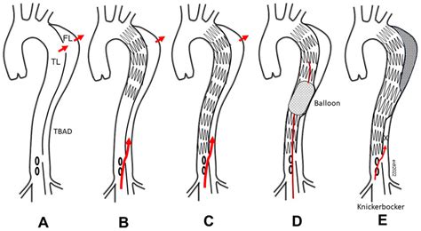 Illustration Of The Knickerbocker Technique A Type B Aortic