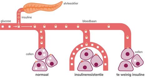 Hoe Ontstaat Diabetes Type 2 Diabetes Nl