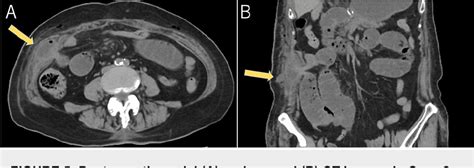 Figure 5 From Preventing An 8 Mm Port Site Hernia In Robot Assisted