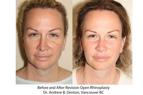 Before And After Revision Rhinoplasty Dr Andrew B Denton Vancouver