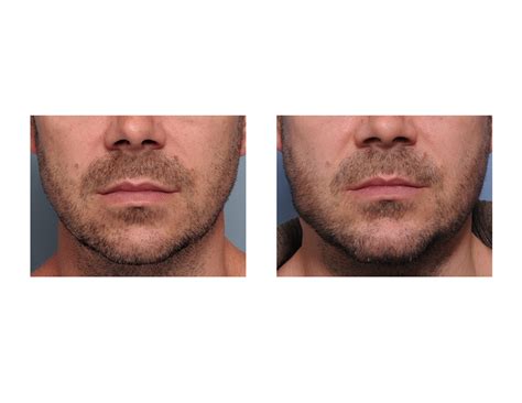 Plastic Surgery Case Study Male Custom Implant For Jawline Definition