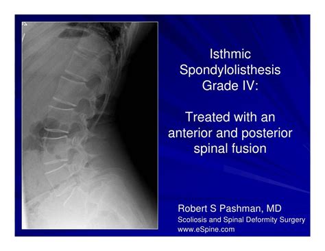 Case Review #1: 16 year old with Isthmic Spondylolisthesis Grade IV