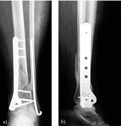 Plate Fixation Versus Percutaneous Rush Pinning For Osteosynthesis Of