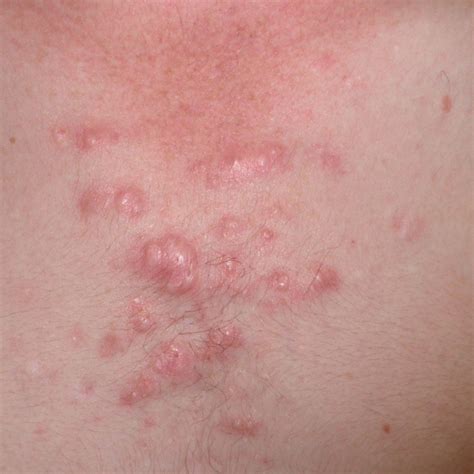 Liver Disease Rash Pictures Photos