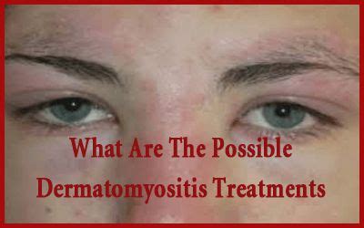 Dermatomyositis OR Heliotrope Rash Eyelid: Causes, Symptoms, Diagnosis ...