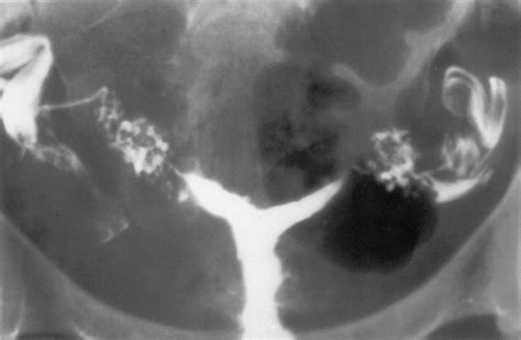 Hysterosalpingography Fertility And Sterility