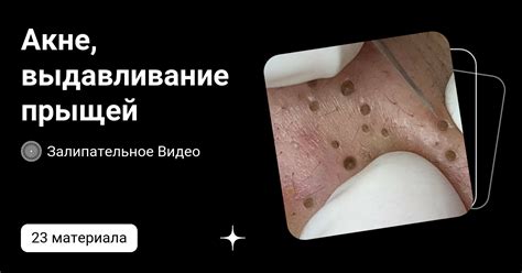 Акне, выдавливание прыщей | Залипательное Видео | Дзен