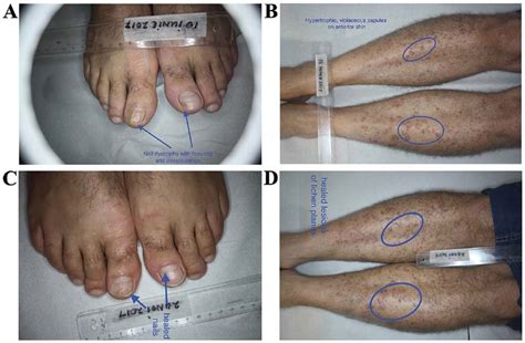 A Lichen Planus Nail Dystrophy With Discoloration And Fissuring Of