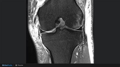 Knee Summit: Surgical Decision-Making and Rationale for MCL Repair and ...