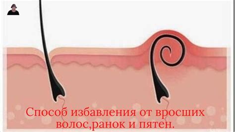 Как ИЗБАВИТЬСЯ от ВРОСШИХ ВОЛОС,РАНОК и ПЯТЕН за 3 ДНЯ/ А ты знал? в ...
