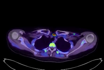 Parathyroid adenoma | Radiology Case | Radiopaedia.org