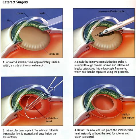 Managing Cataract Surgery Timing And Recovery Insights Cygnus Study