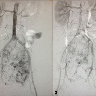 Arteriography Showing Arterial Vascularization Of The Mass Before The