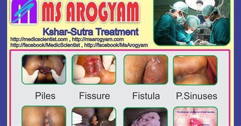 Piles And Fistula Treatment By Kshar Sutra Ayurveda ANAL FISSURES Ayurvedic Treatment