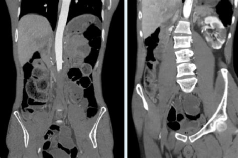 What Is A CT Angiography CTA Scan 2023 Guide Bel India