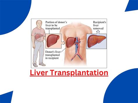 Liver Transplantation Surgery In India Liver Transplant Is Flickr