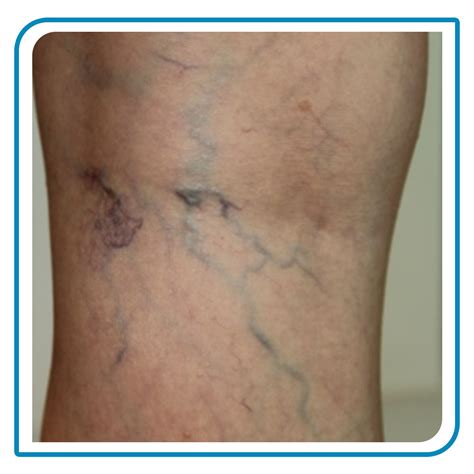 Spider Veins Treatemnt In Thane Surekha Varicose Veins Clinic Laser