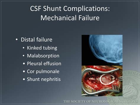 PPT - Emergency Evaluation of Hydrocephalus Shunt Patients PowerPoint Presentation - ID:2079100