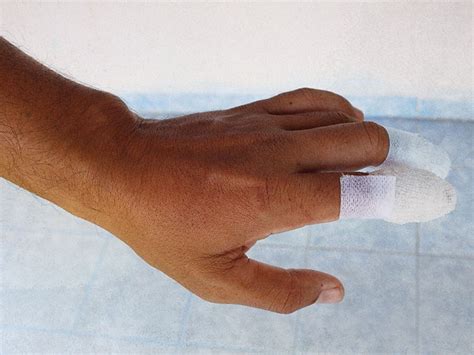 Cut-off finger: First aid, treatment, and recovery