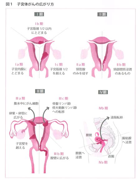 子宮体がん 島根大学医学部附属病院 産科婦人科