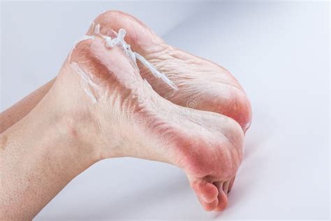 Dehydrated Skin Female Heels Stock Image Image Of Hard Fungus 103284207